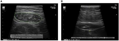Phase angle and rectus femoris cross-sectional area as predictors of severe malnutrition and their relationship with complications in outpatients with post-critical SARS-CoV2 disease